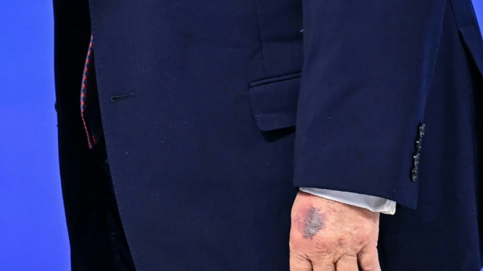 Trump bruised hand on table, White House says of new photos