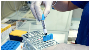 Alzheimer, un test del sangue potrebbe predire chi svilupper&agrave; sintomi tra 5-10 anni