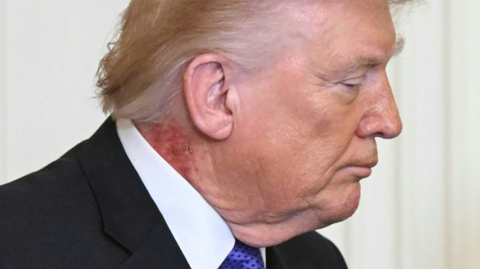Trump es visto con una gran mancha roja en el cuello